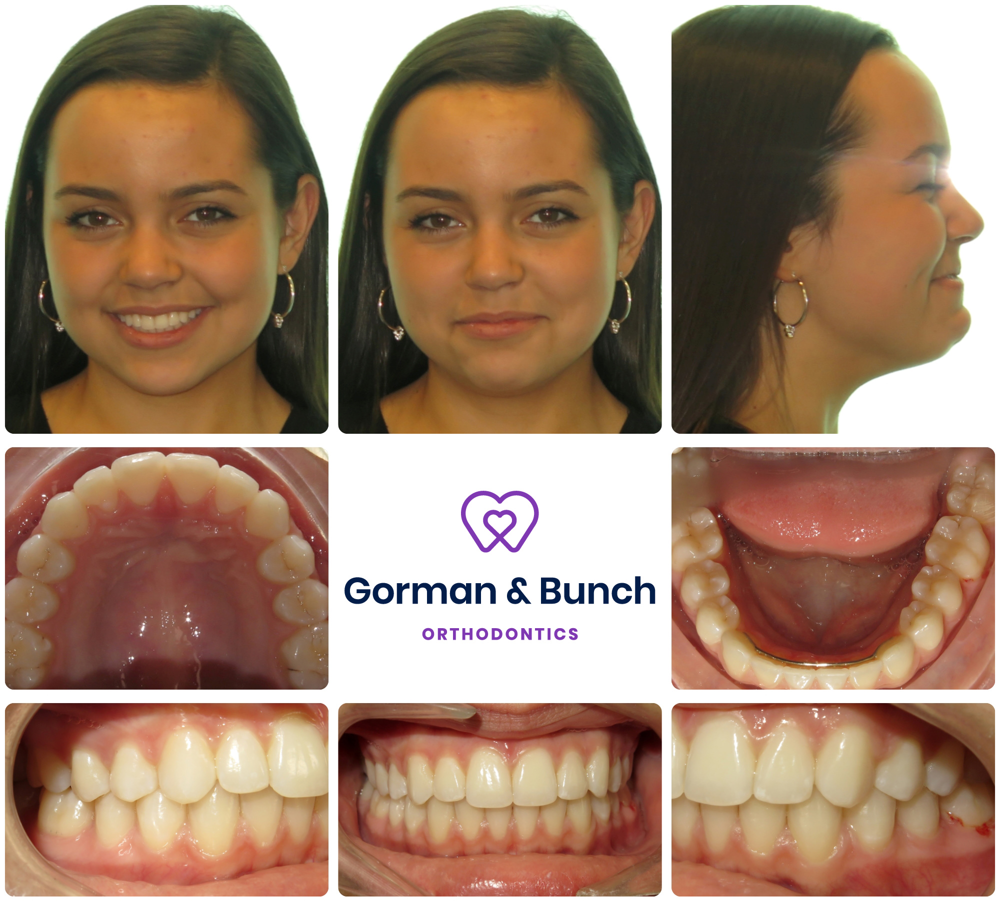 invisalign before and after - overbite - carmel indiana - fnv - 2